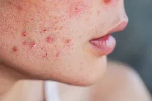ニキビケア